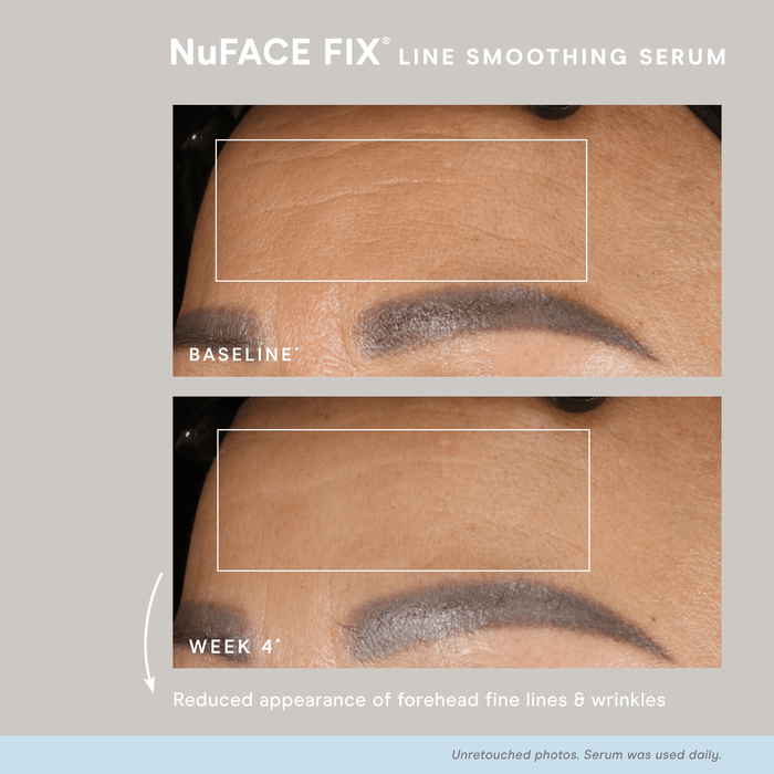 Close-up comparison showing reduced forehead fine lines and wrinkles after four weeks of daily use of NuFACE FIX® Serum | NuFACE, highlighting smoother skin texture and improved appearance.
