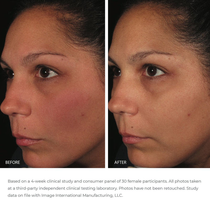 Before and after comparison of a woman’s face showing improved skin clarity and reduced redness after using ORMEDIC balancing antioxidant serum | IMAGE Skincare.